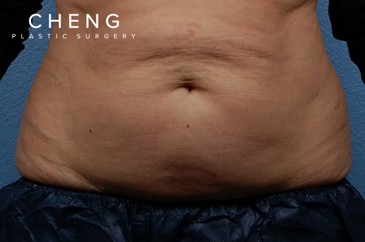 CoolSculpting Before & After Gallery - Patient 290235 - Image 1