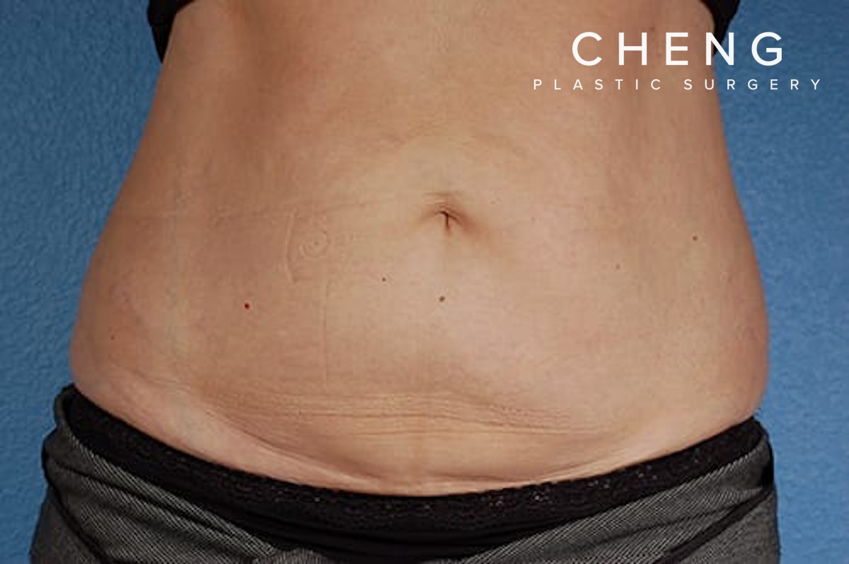 CoolSculpting Before & After Gallery - Patient 290235 - Image 2