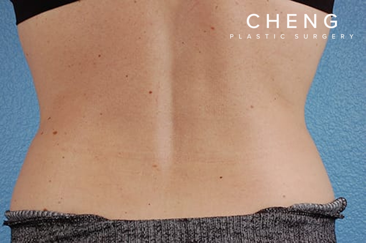 CoolSculpting Before & After Gallery - Patient 184876 - Image 2