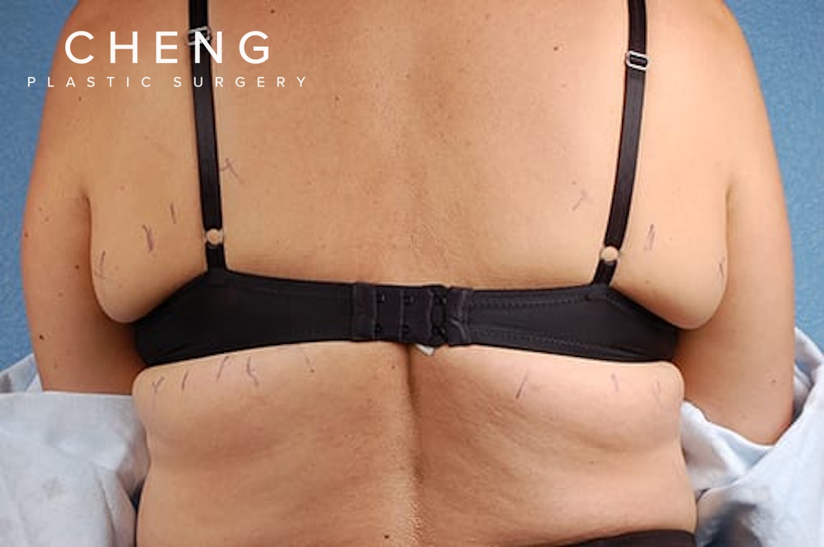 Hidden Patients Before & After Gallery - Patient 100173 - Image 1