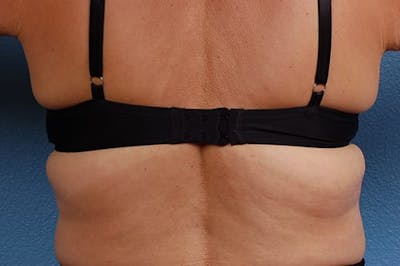 Hidden Patients Before & After Gallery - Patient 100173 - Image 2