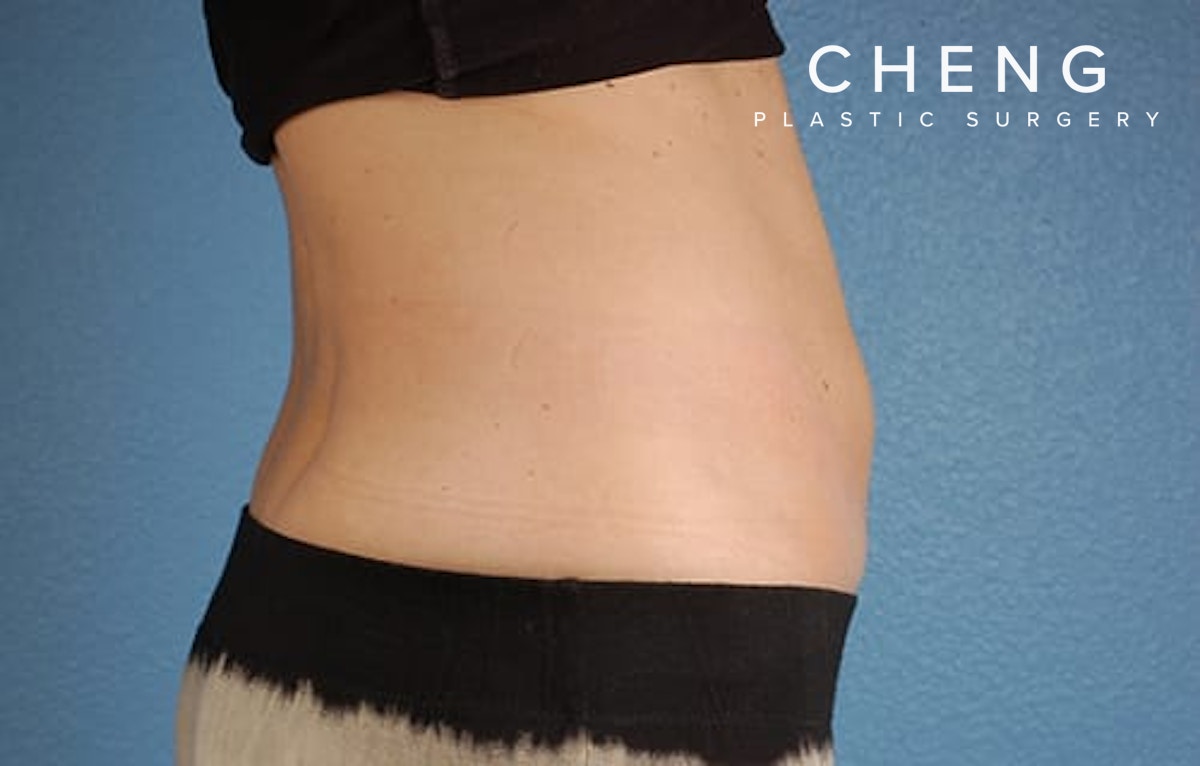 CoolSculpting Before & After Gallery - Patient 126163 - Image 6