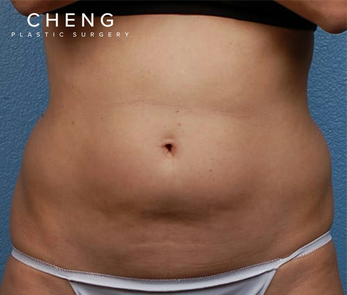 Hidden Patients Before & After Gallery - Patient 162999 - Image 1