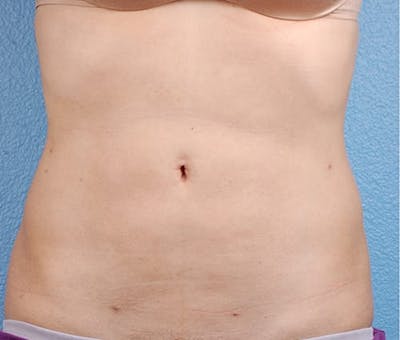 Hidden Patients Before & After Gallery - Patient 162999 - Image 2