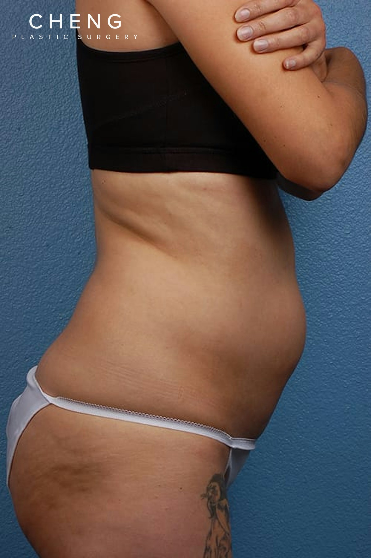 Hidden Patients Before & After Gallery - Patient 162999 - Image 5