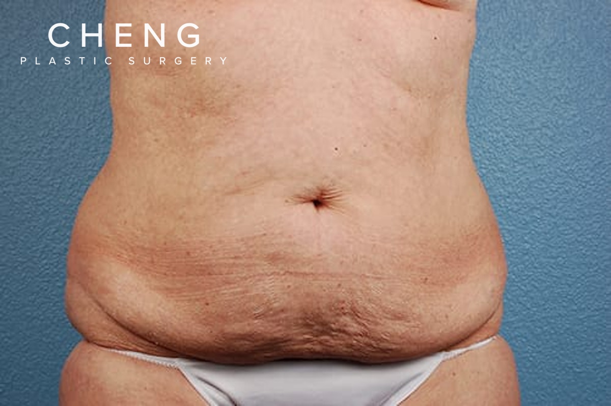 Hidden Patients Before & After Gallery - Patient 107940 - Image 1