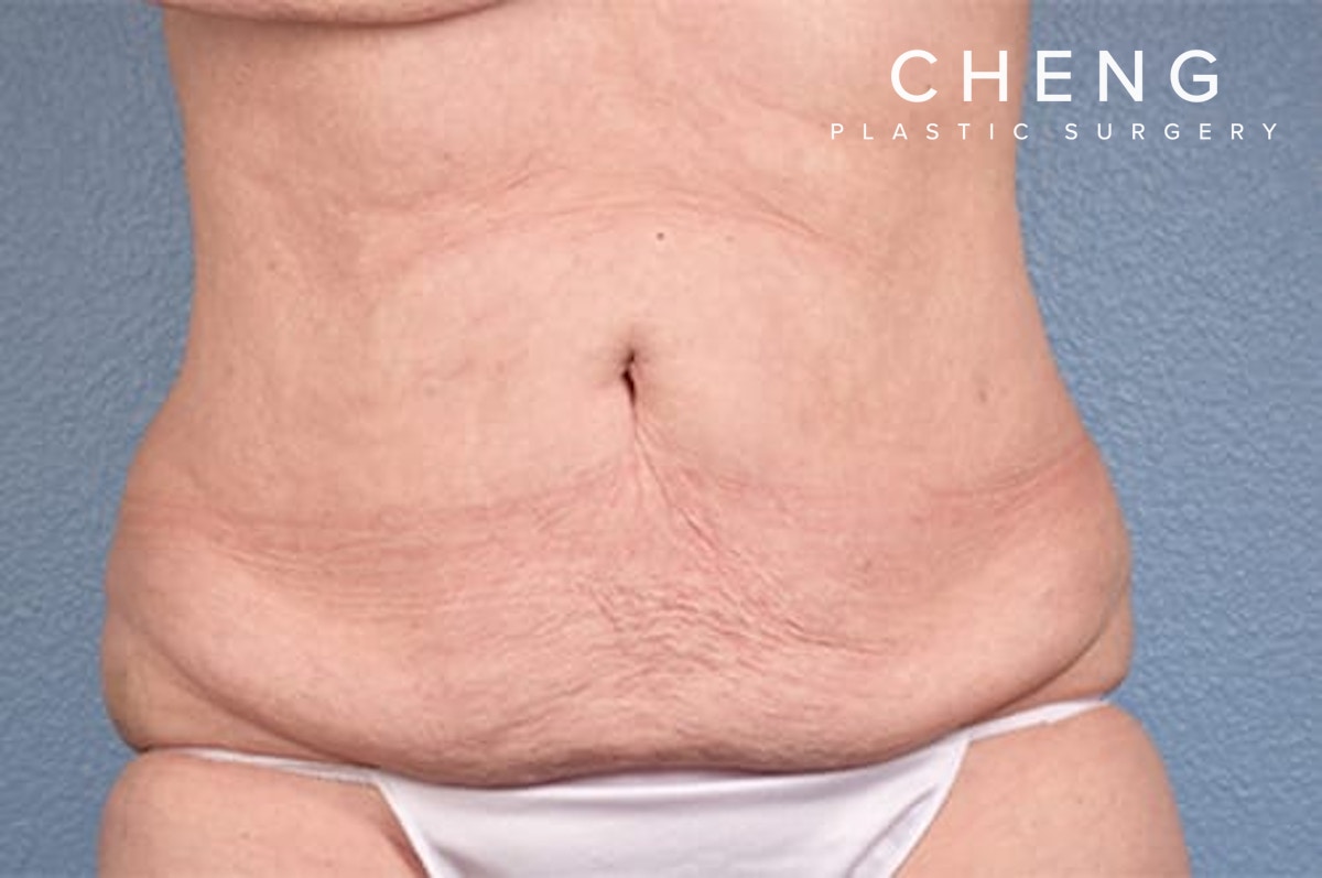 Hidden Patients Before & After Gallery - Patient 107940 - Image 2