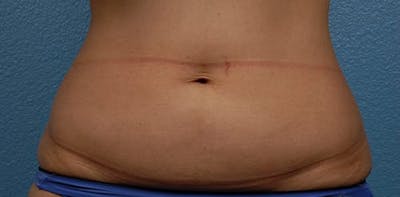 Hidden Patients Before & After Gallery - Patient 331001 - Image 1