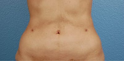 Hidden Patients Before & After Gallery - Patient 331001 - Image 2
