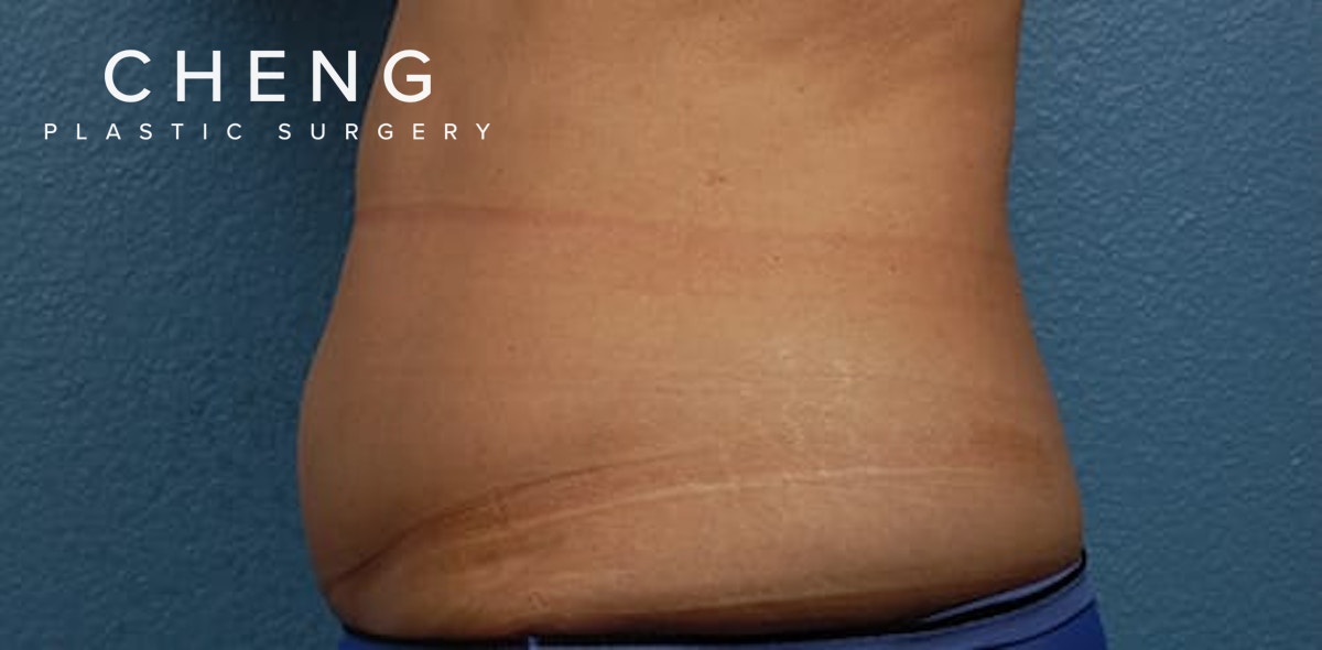 Hidden Patients Before & After Gallery - Patient 331001 - Image 3