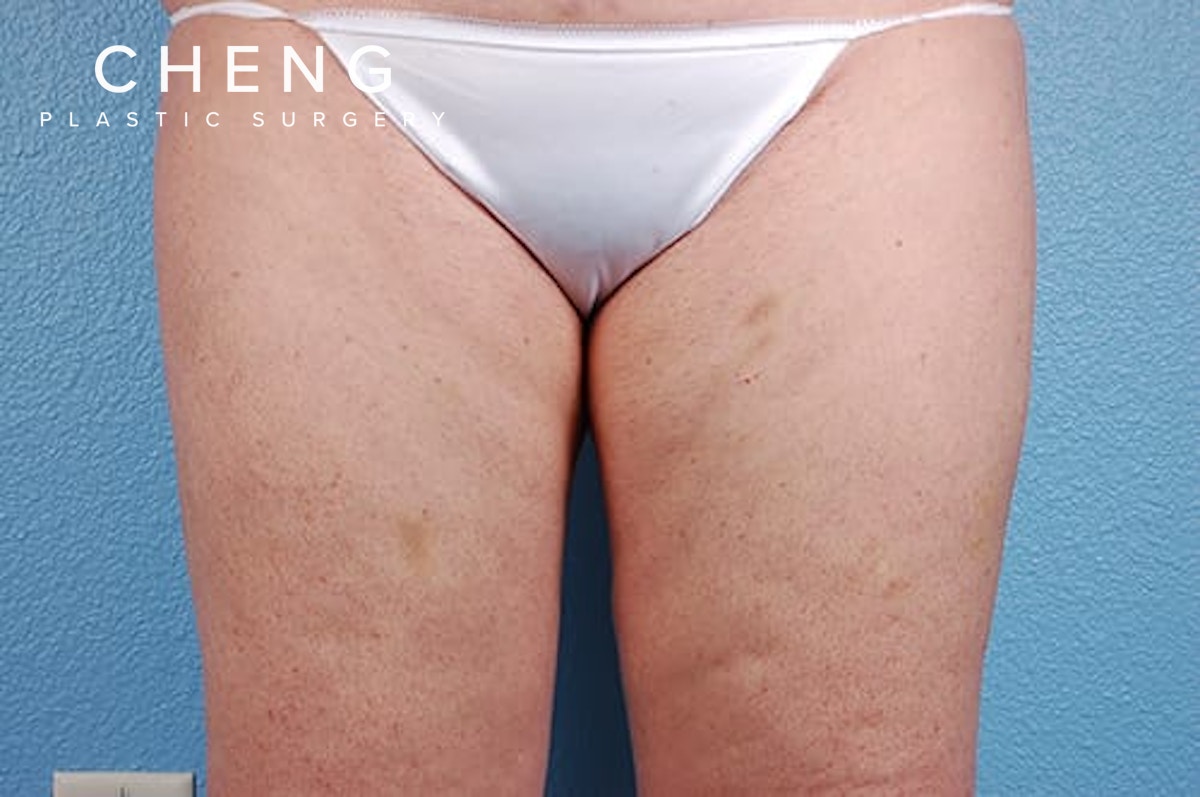 Hidden Patients Before & After Gallery - Patient 113163 - Image 1