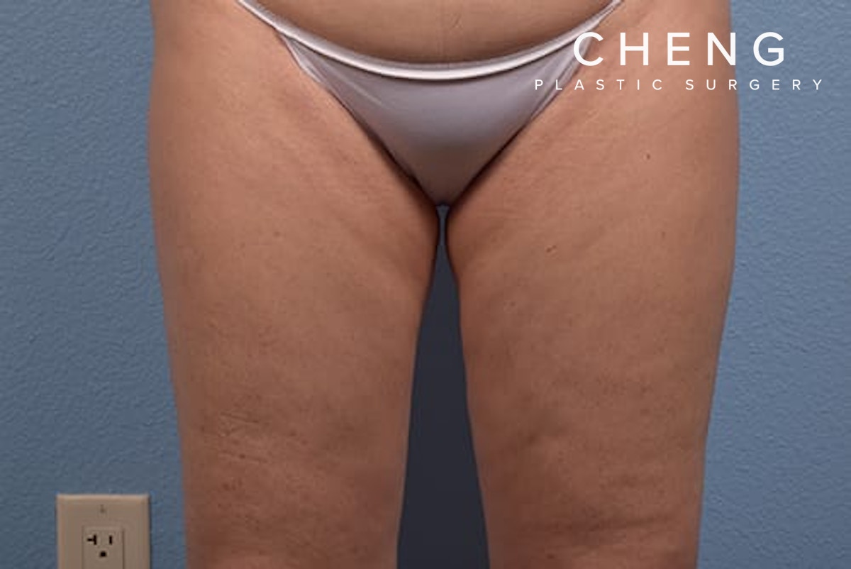 Hidden Patients Before & After Gallery - Patient 113163 - Image 2