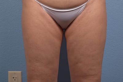 Hidden Patients Before & After Gallery - Patient 113163 - Image 2
