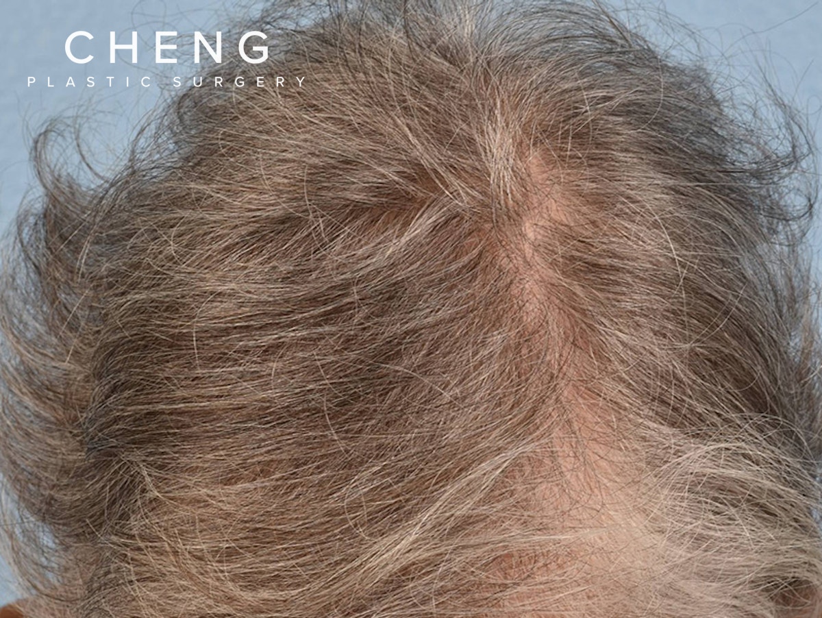 Hair Rejuvenation With PRP Before & After Gallery - Patient 592519 - Image 1