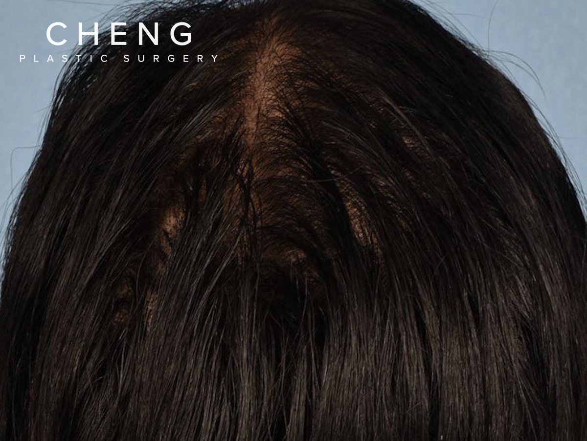 Hair Rejuvenation With PRP Before & After Gallery - Patient 291923 - Image 1