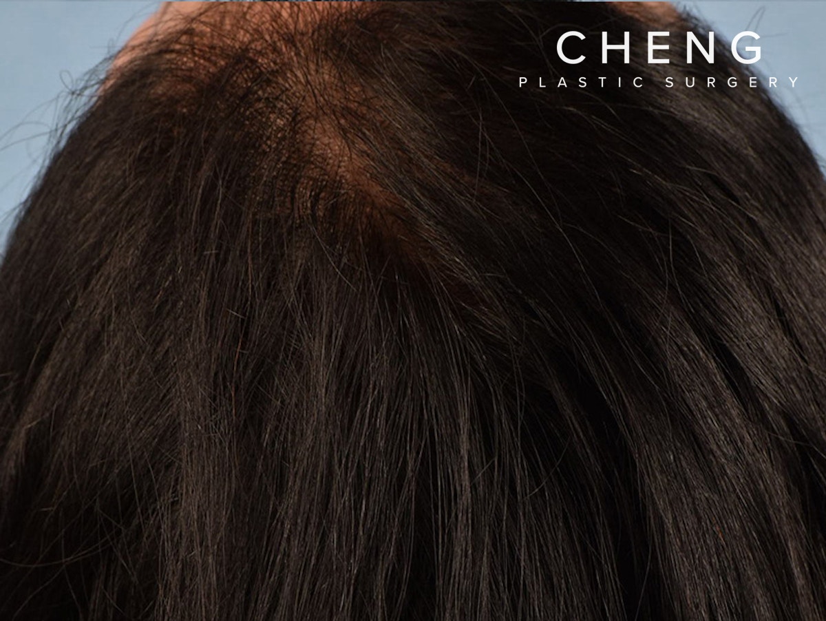 Hair Rejuvenation With PRP Before & After Gallery - Patient 291923 - Image 2