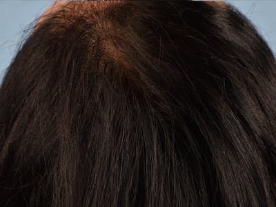 Hair Rejuvenation With PRP Before & After Gallery - Patient 291923 - Image 2