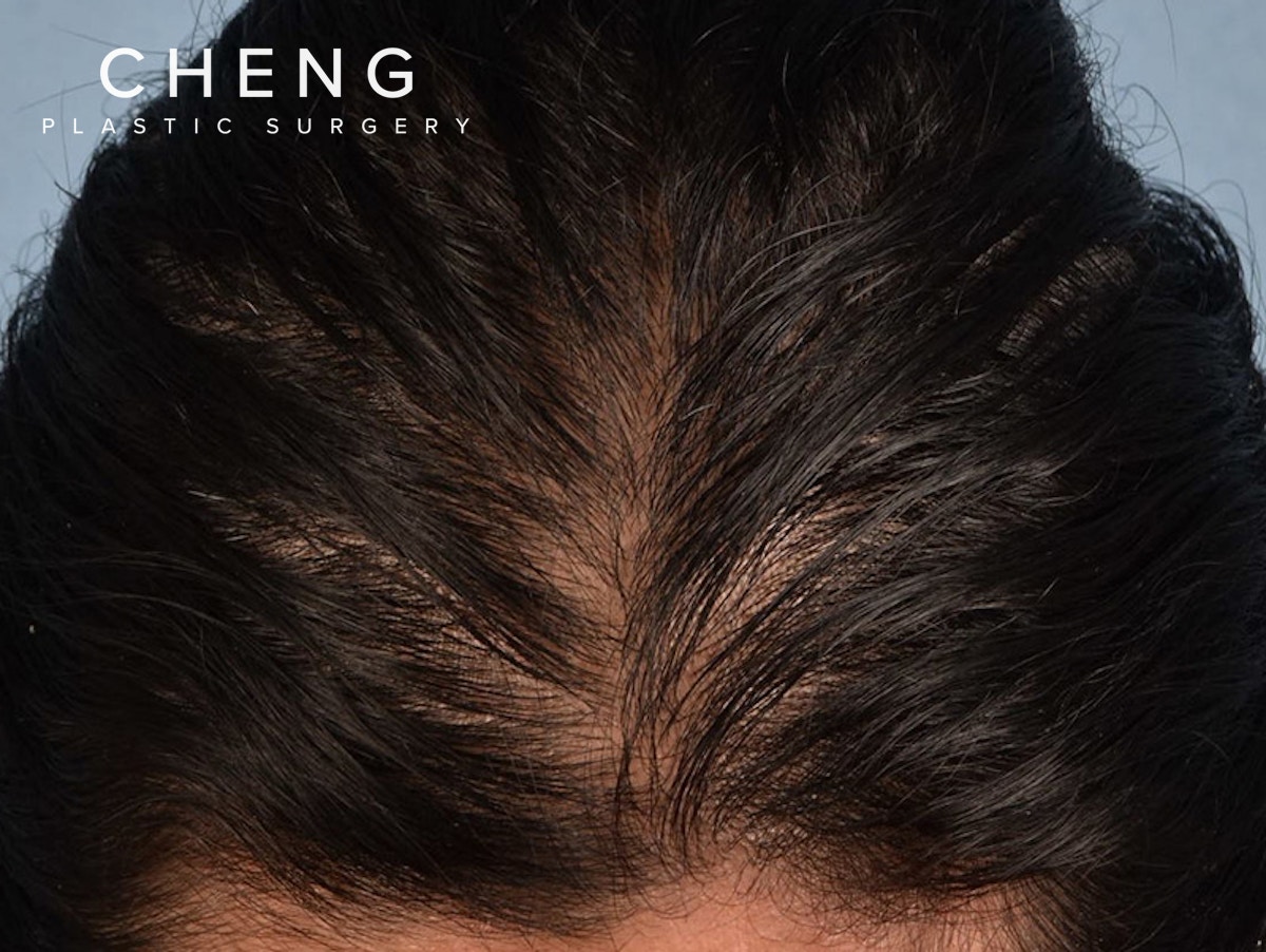 Hair Rejuvenation With PRP Before & After Gallery - Patient 291923 - Image 3