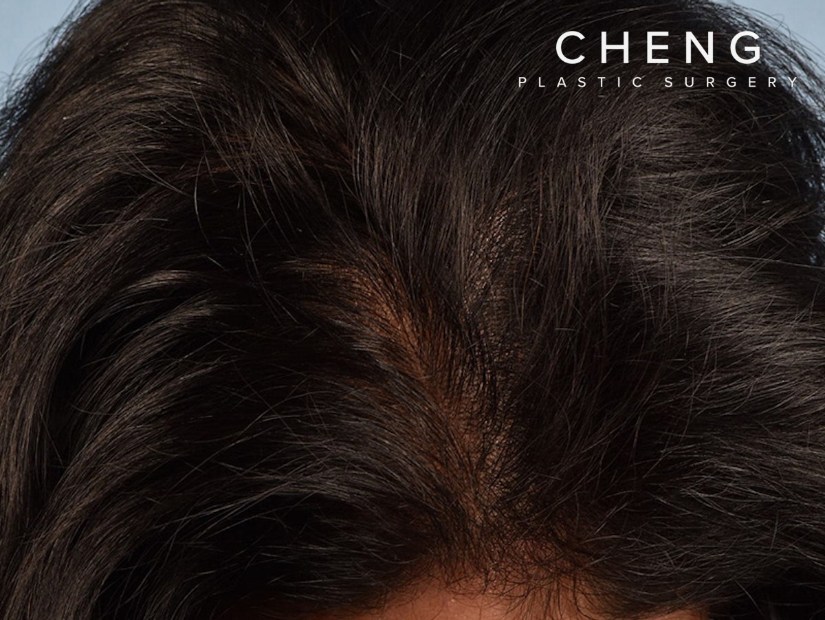 Hair Rejuvenation With PRP Before & After Gallery - Patient 291923 - Image 4