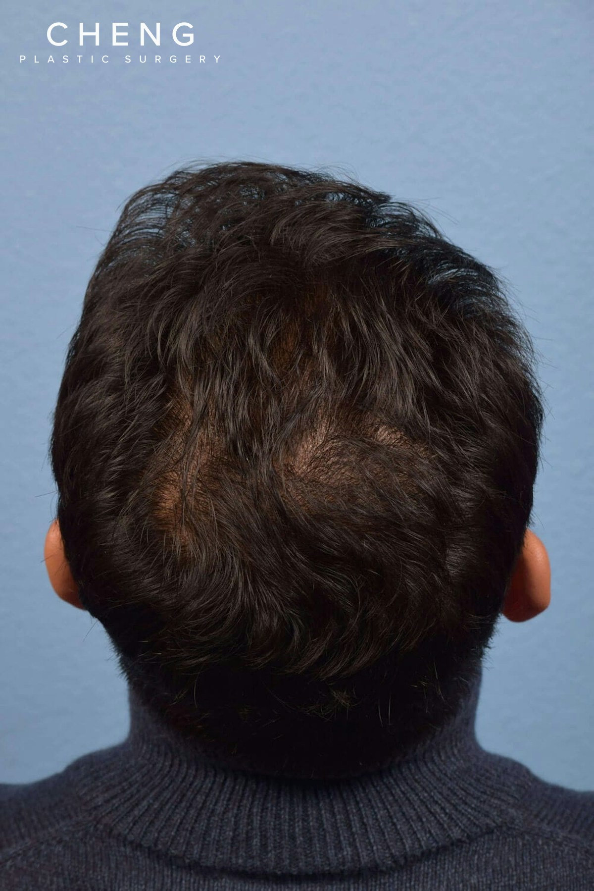 Hair Rejuvenation With PRP Before & After Gallery - Patient 376942 - Image 1