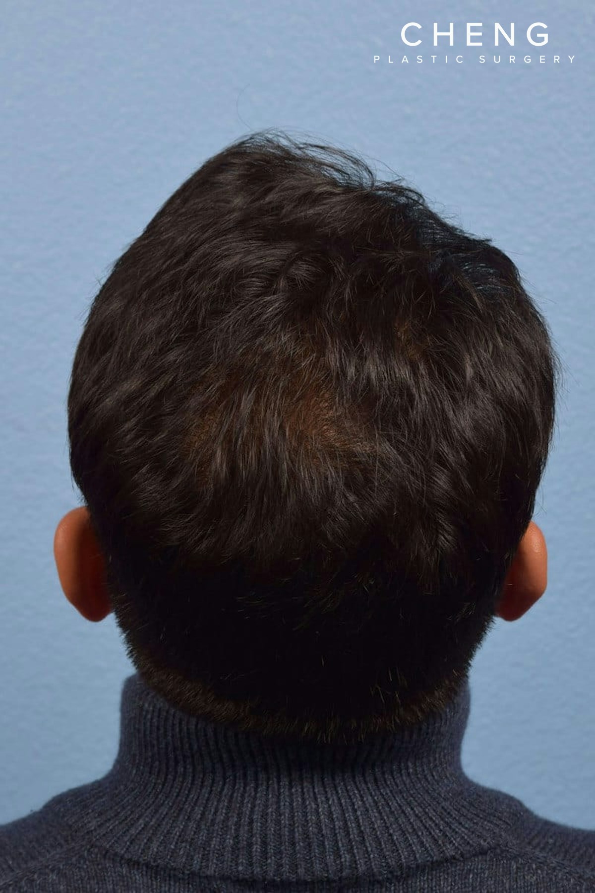 Hair Rejuvenation With PRP Before & After Gallery - Patient 376942 - Image 2