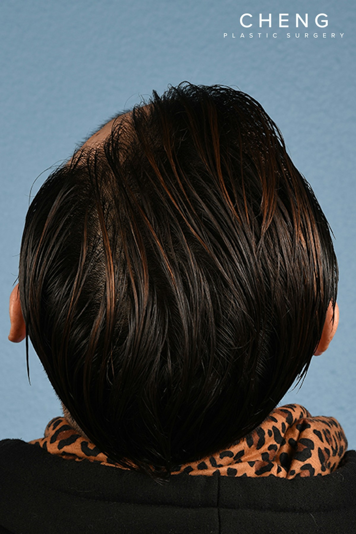 Hidden Patients Before & After Gallery - Patient 381194 - Image 2