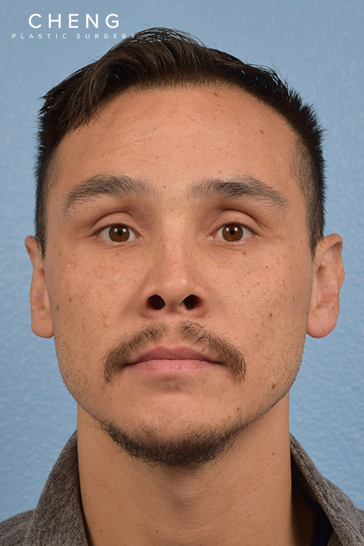 Hidden Patients Before & After Gallery - Patient 381194 - Image 3