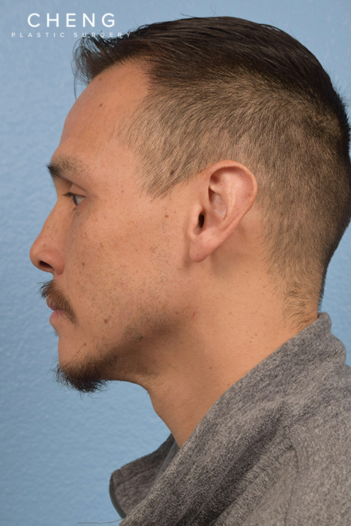 Hidden Patients Before & After Gallery - Patient 381194 - Image 5