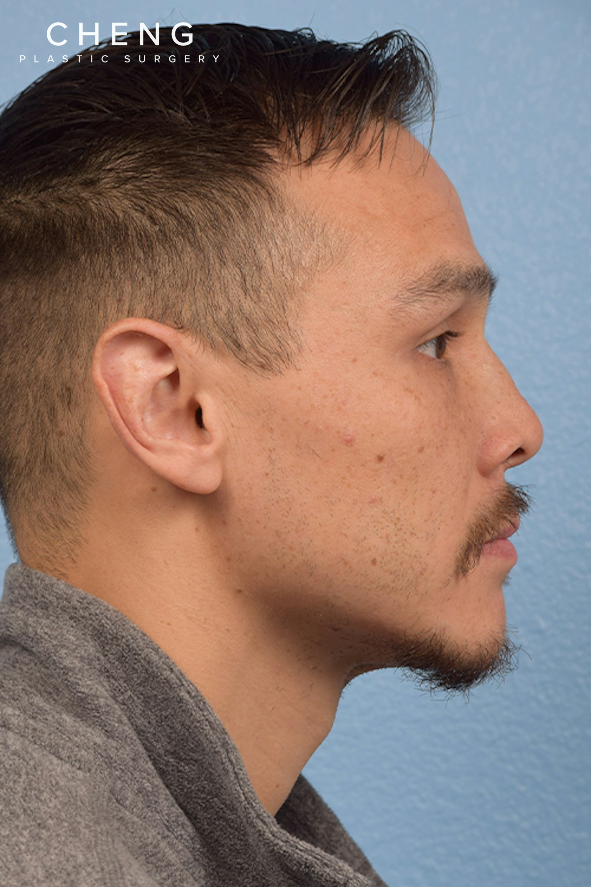 Hidden Patients Before & After Gallery - Patient 381194 - Image 7