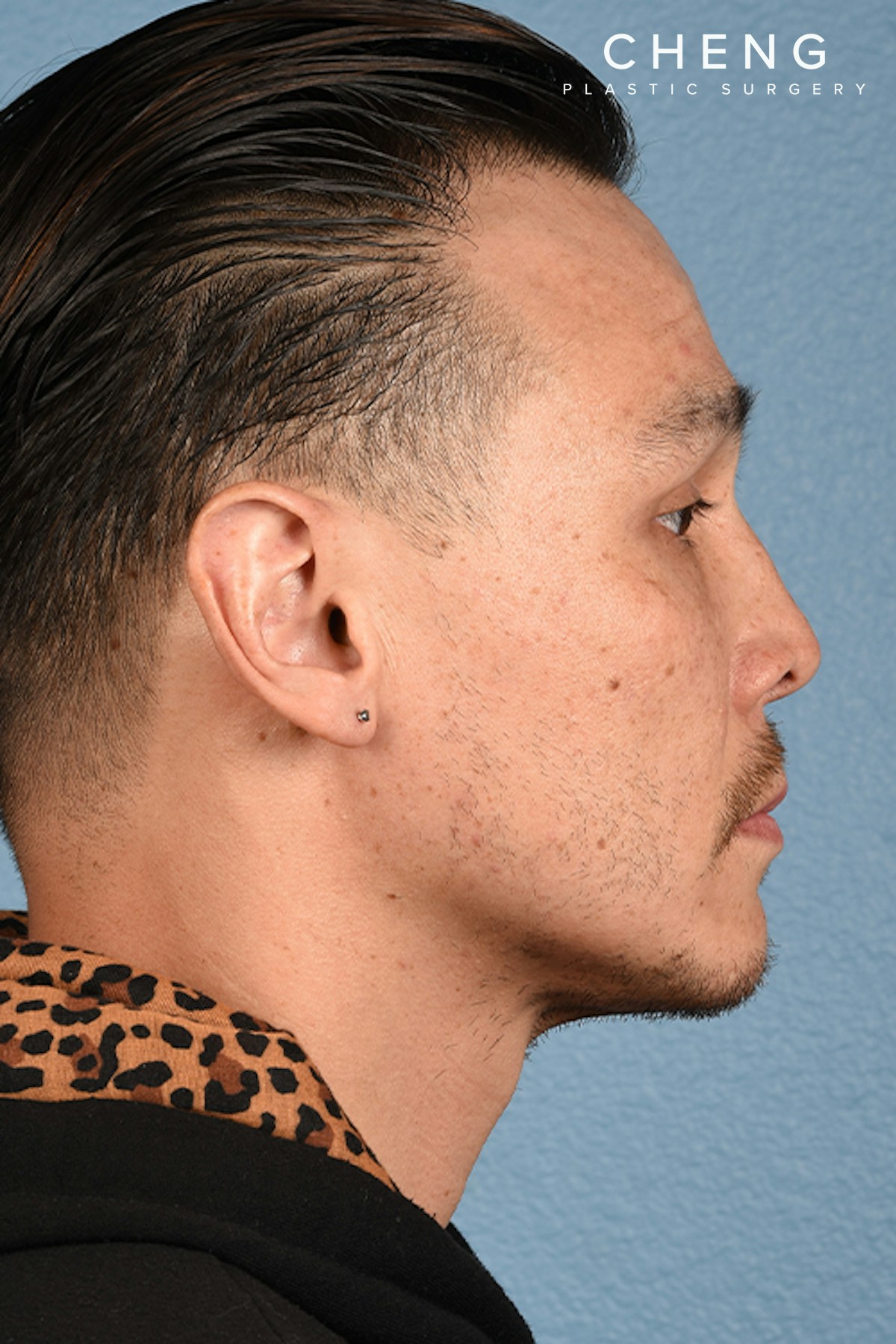 Hidden Patients Before & After Gallery - Patient 381194 - Image 8