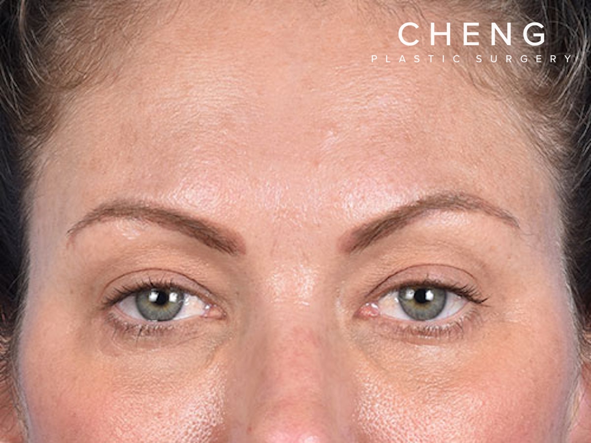 Blepharoplasty Before & After Gallery - Patient 213842 - Image 2