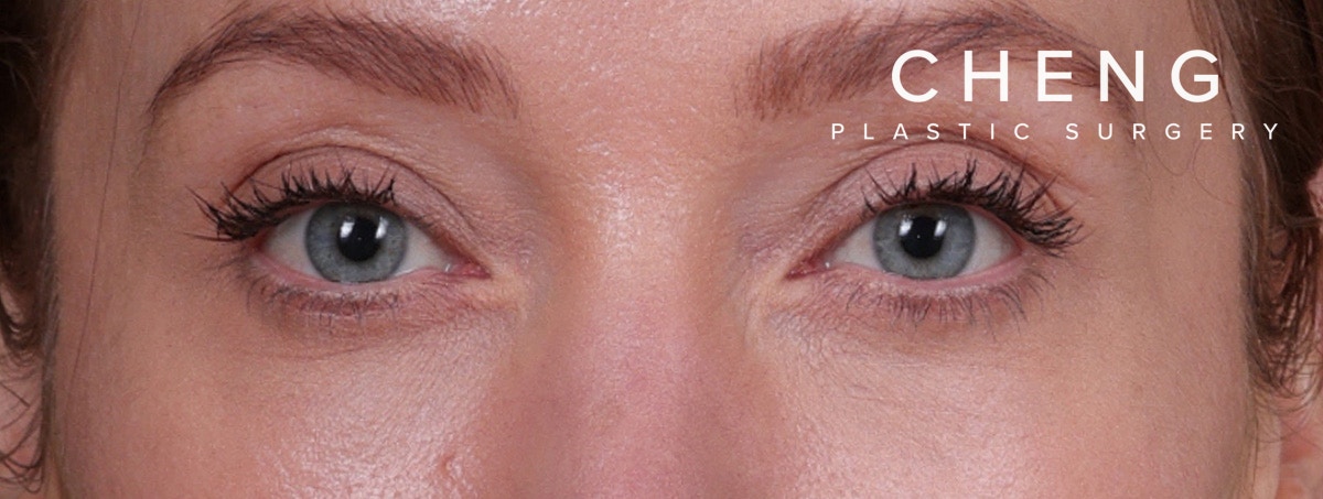 Blepharoplasty Before & After Gallery - Patient 310704 - Image 2