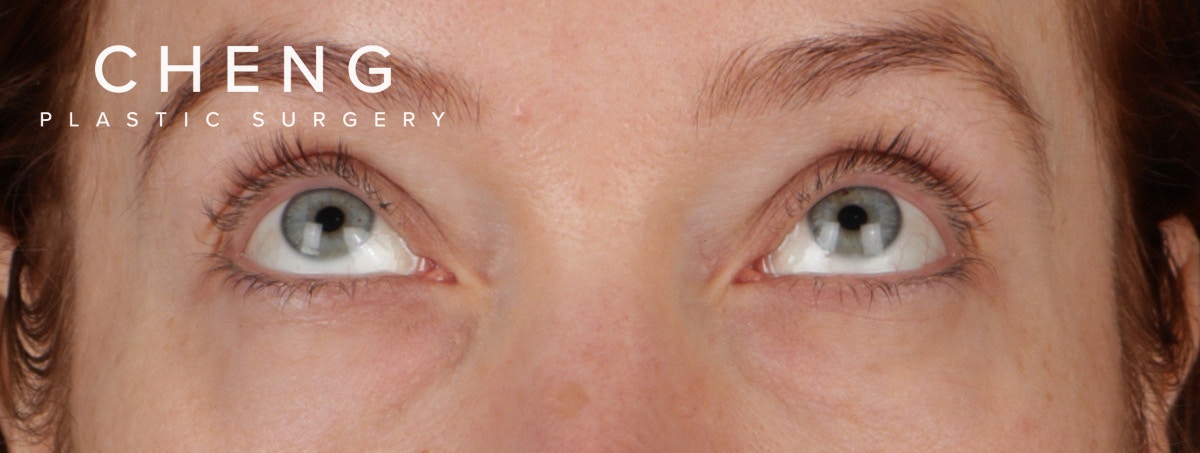 Blepharoplasty Before & After Gallery - Patient 310704 - Image 3