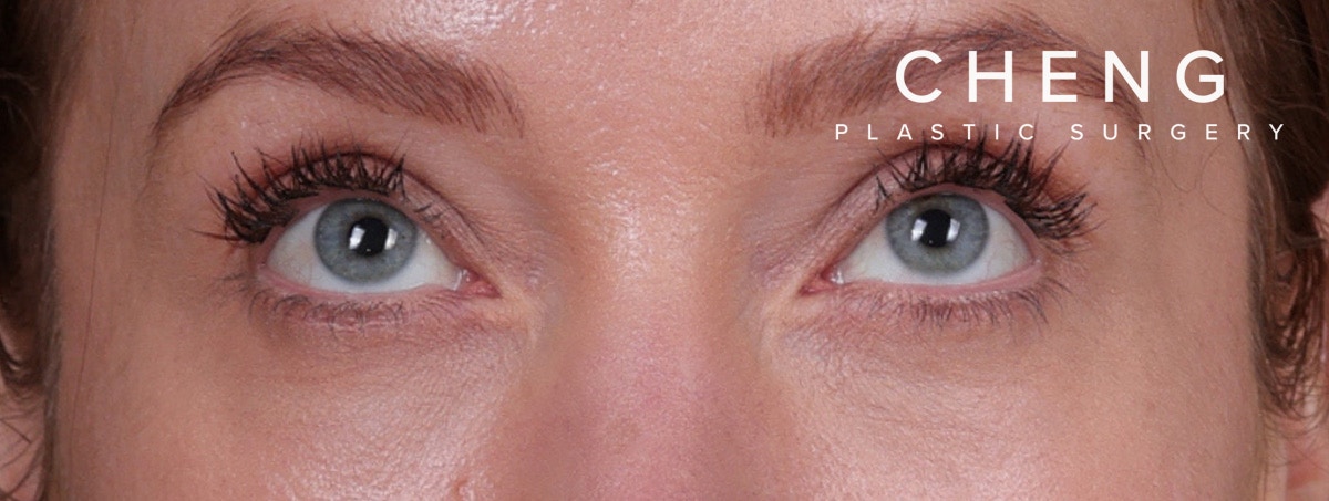 Blepharoplasty Before & After Gallery - Patient 310704 - Image 4