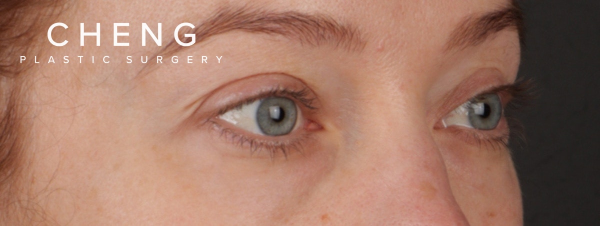 Blepharoplasty Before & After Gallery - Patient 310704 - Image 5