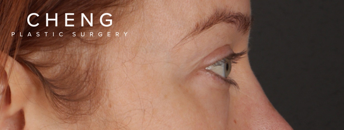 Blepharoplasty Before & After Gallery - Patient 310704 - Image 7