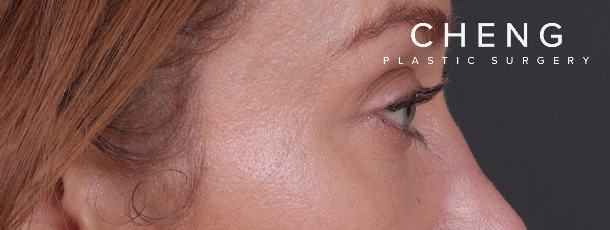 Blepharoplasty Before & After Gallery - Patient 310704 - Image 8
