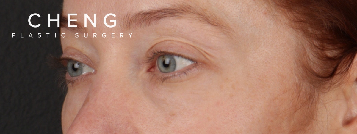 Blepharoplasty Before & After Gallery - Patient 310704 - Image 9