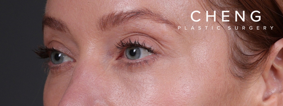 Blepharoplasty Before & After Gallery - Patient 310704 - Image 10