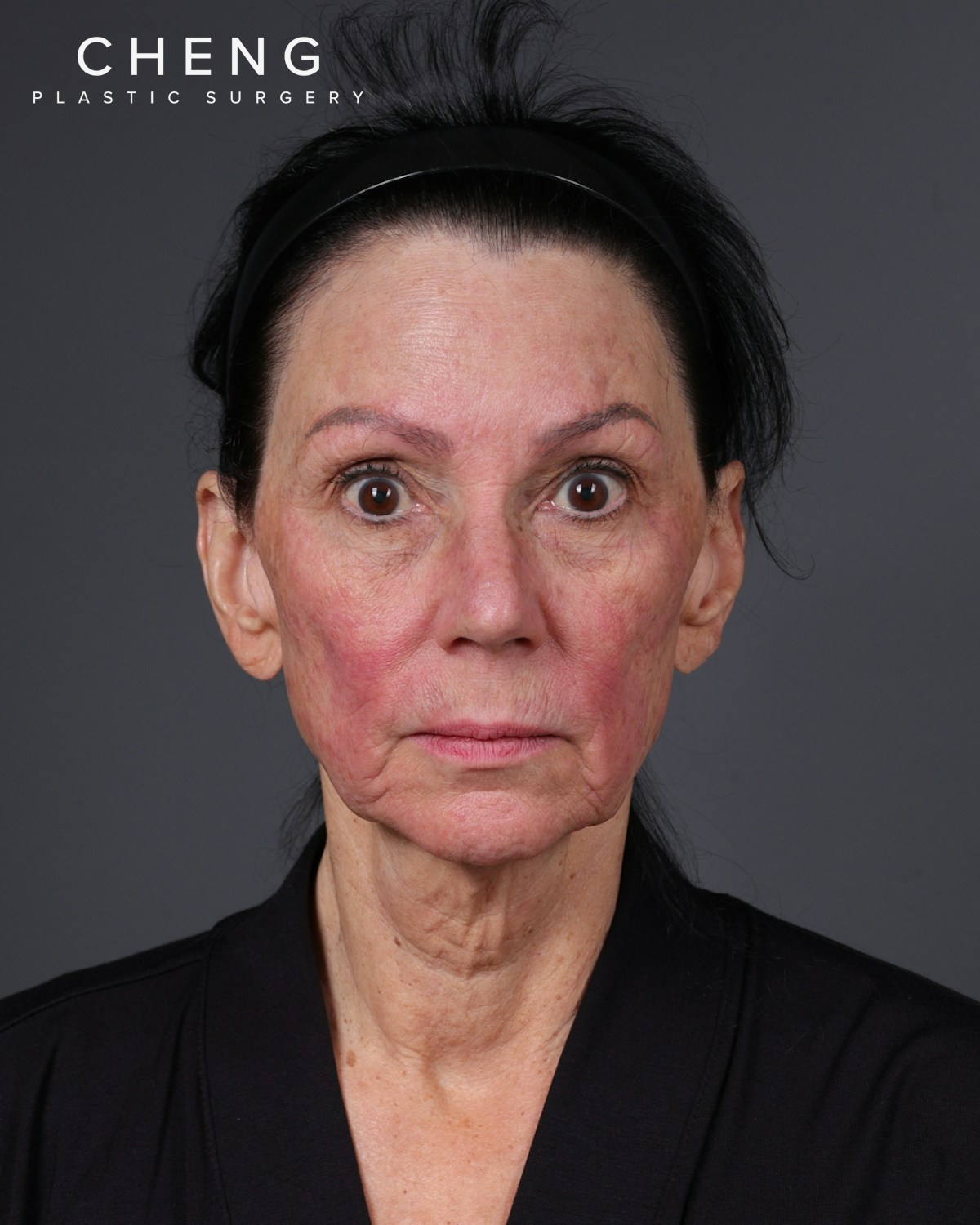 Facelift Before & After Gallery - Patient 199753 - Image 9
