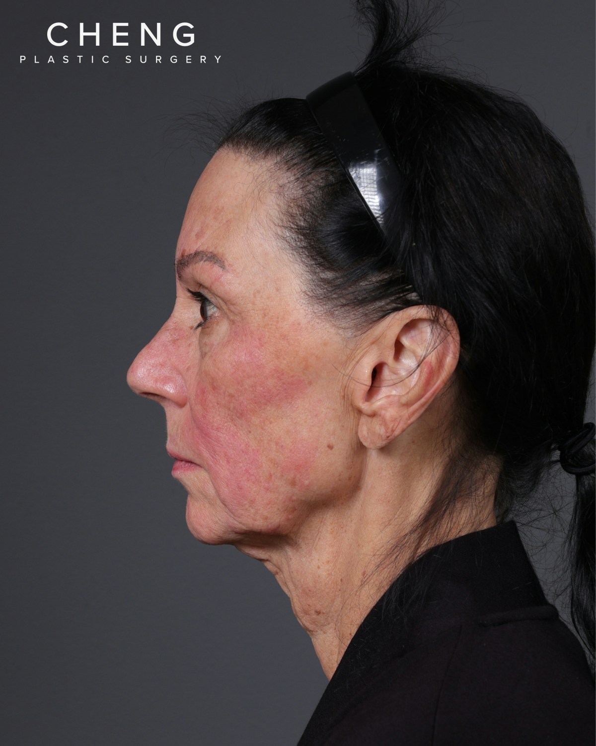 Facelift Before & After Gallery - Patient 199753 - Image 17