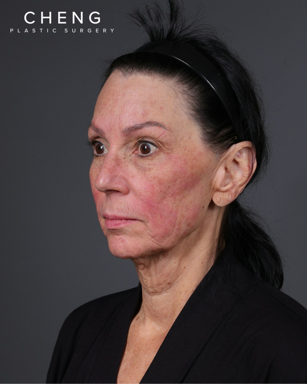 Facelift Before & After Gallery - Patient 199753 - Image 15