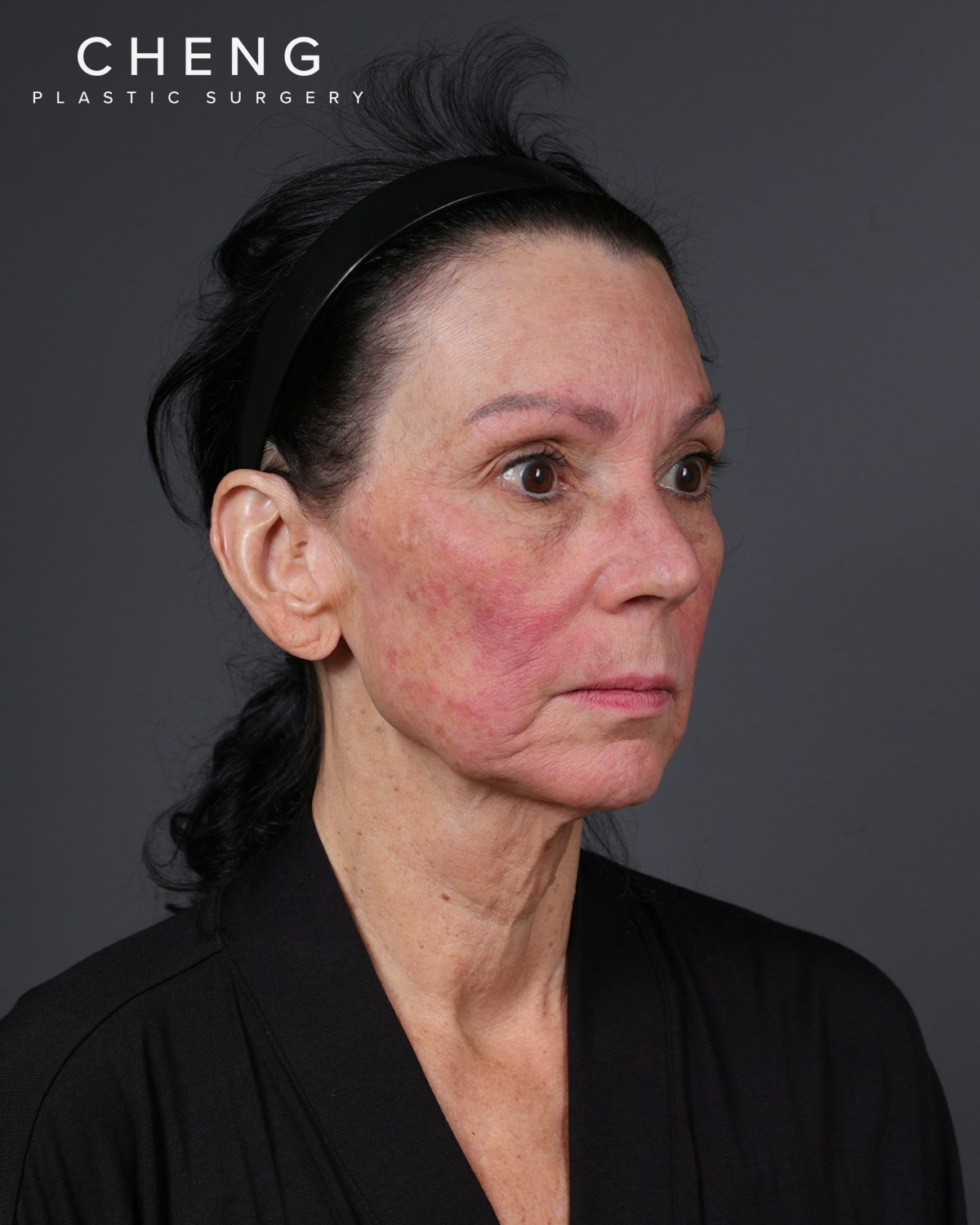 Facelift Before & After Gallery - Patient 199753 - Image 11