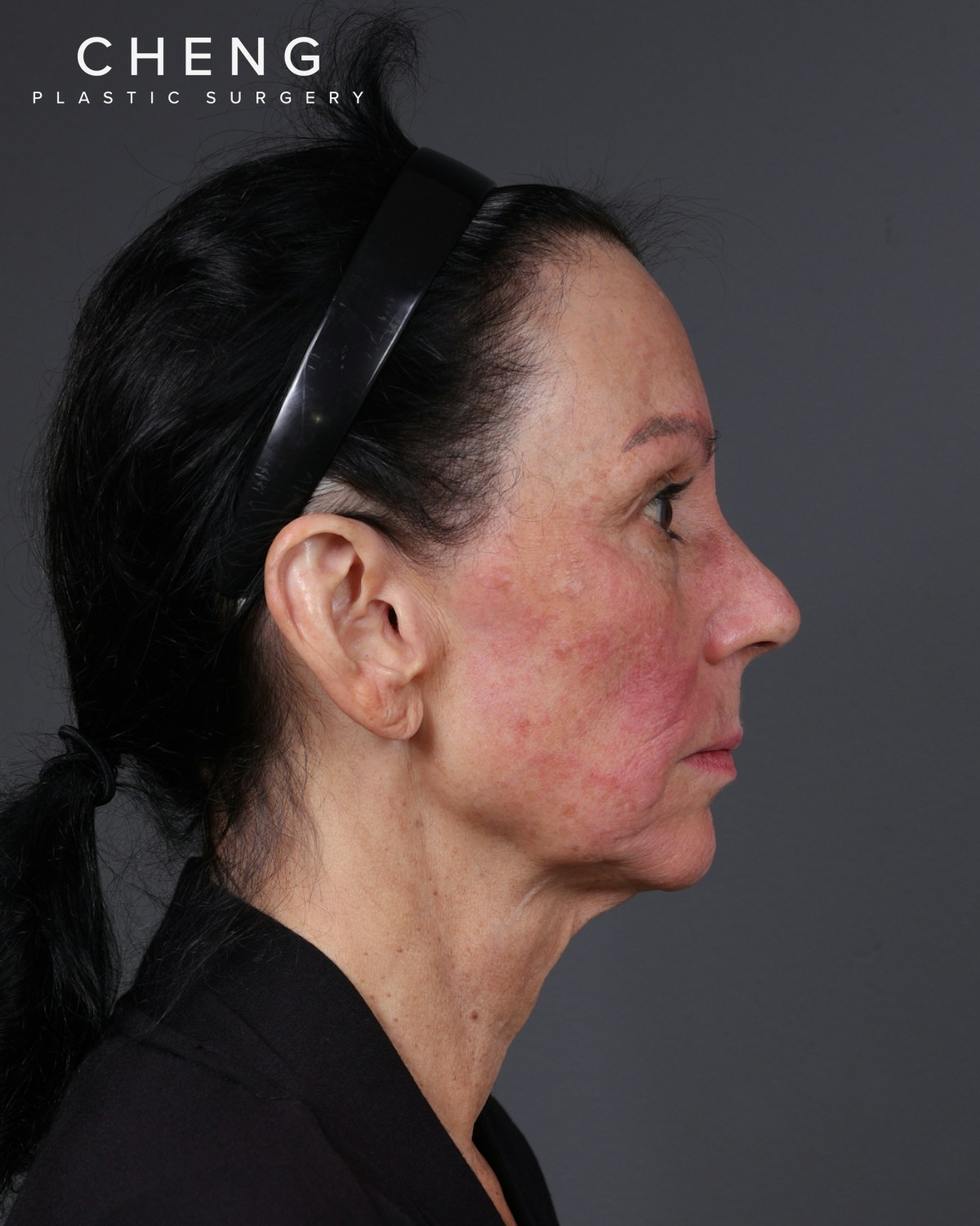 Facelift Before & After Gallery - Patient 199753 - Image 13
