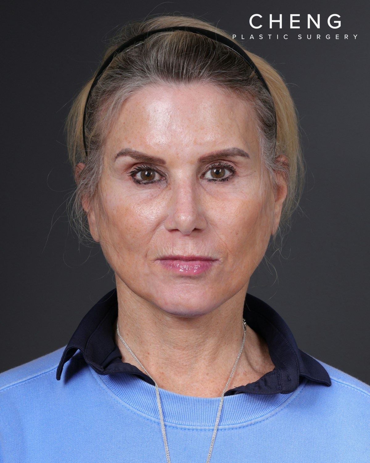 Neck Lift Before & After Gallery - Patient 301904 - Image 2