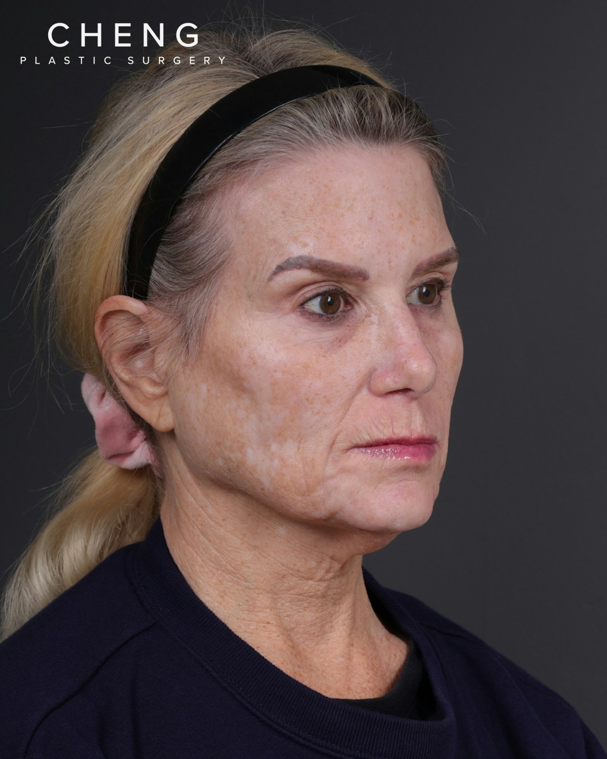 Neck Lift Before & After Gallery - Patient 301904 - Image 3