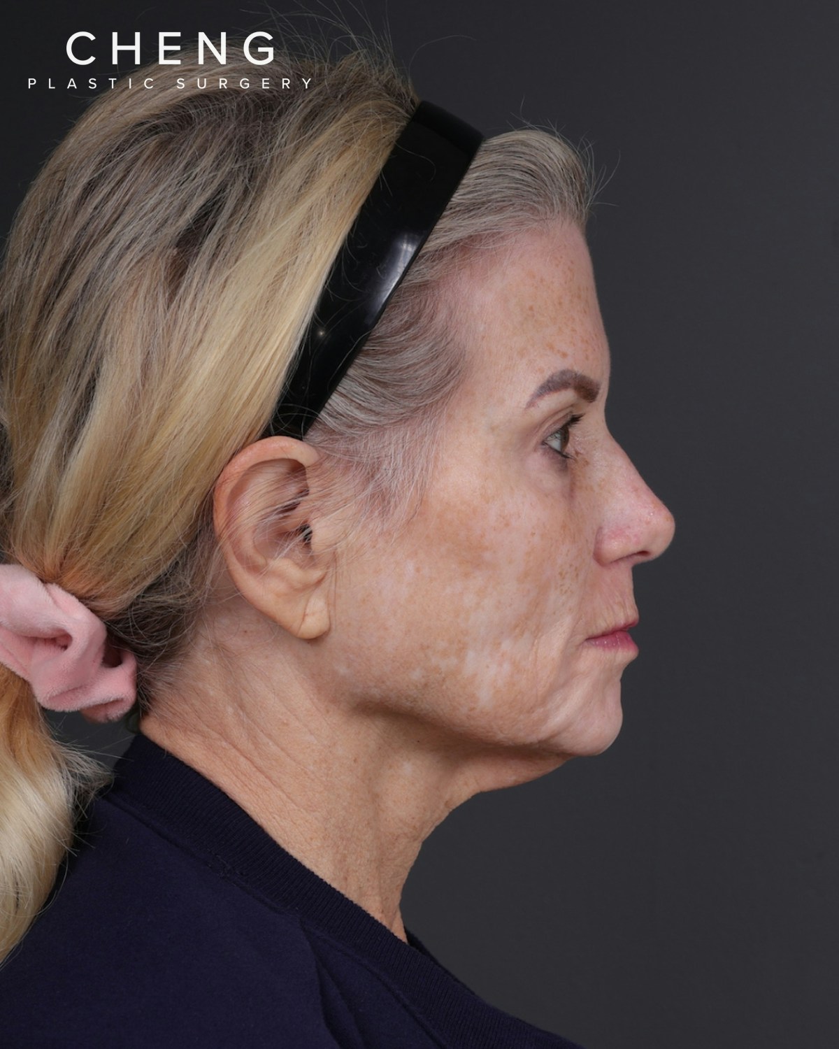 Neck Lift Before & After Gallery - Patient 301904 - Image 5