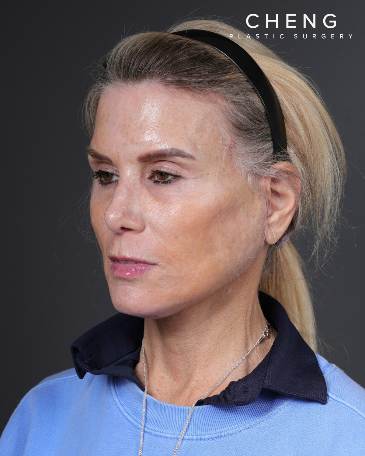 Neck Lift Before & After Gallery - Patient 301904 - Image 8