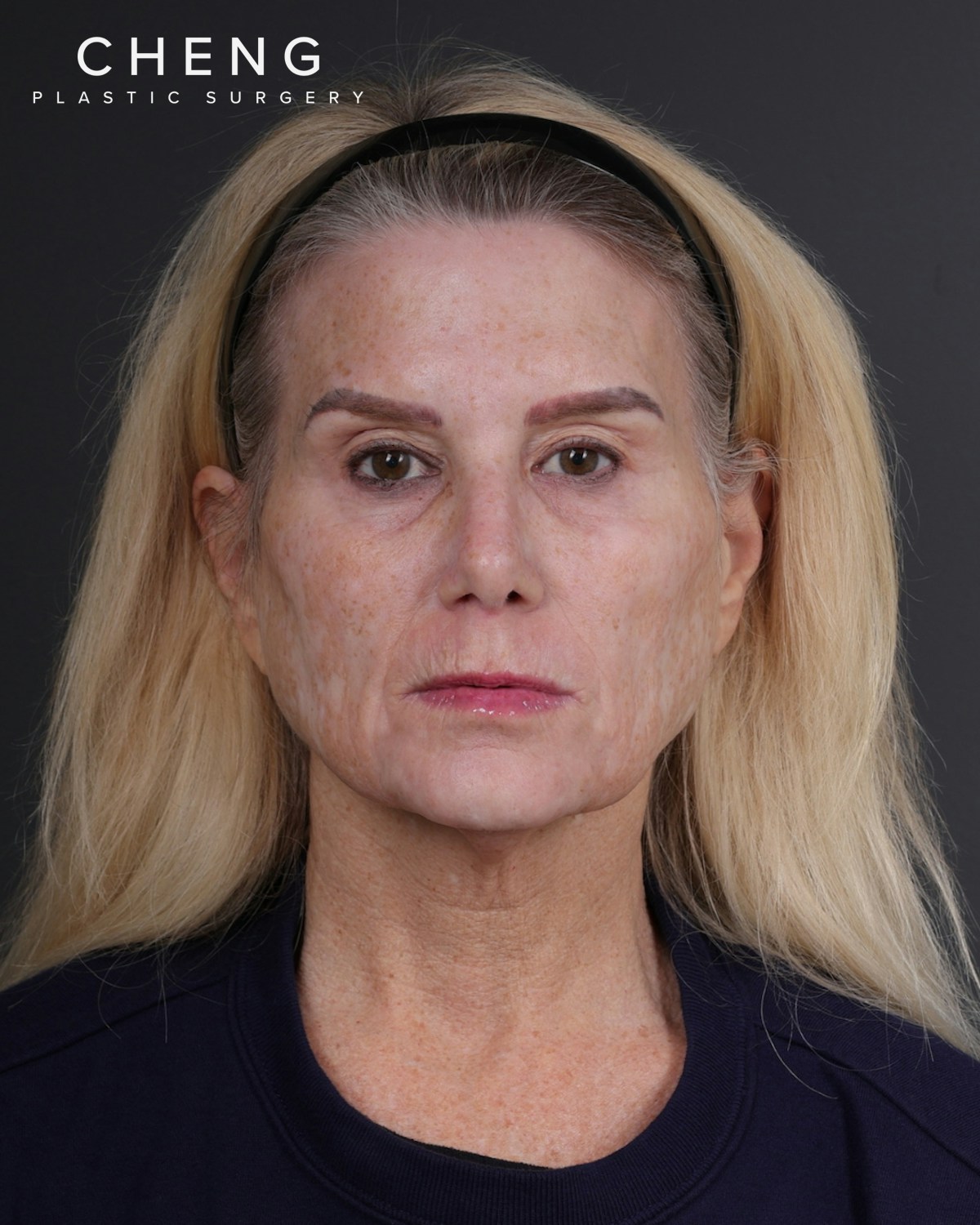 Neck Lift Before & After Gallery - Patient 301904 - Image 1