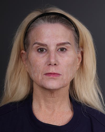 Neck Lift Before & After Gallery - Patient 301904 - Image 1